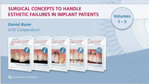 Surgical Concepts to Handle Esthetic Failures in Implant Patients