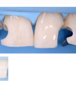 Direct and Indirect Adhesive Restorations