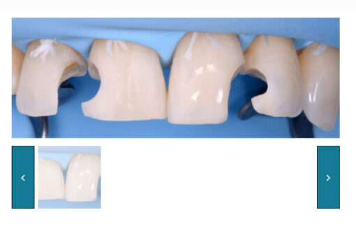 Direct and Indirect Adhesive Restorations