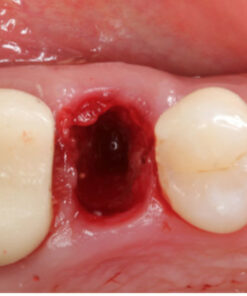 Extraction Socket – Preservation/Grafting: Immediate vs Delayed Implants; Pontic Site Development