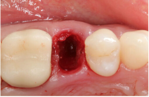 Extraction Socket – Preservation/Grafting: Immediate vs Delayed Implants; Pontic Site Development