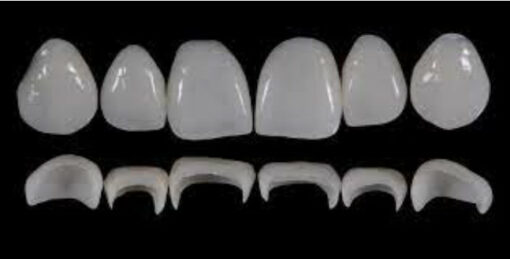 Prosthetic Rehabilitation on Natural Teeth: Predictable, Esthetic and Systematic Steps