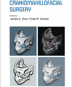 Ebook  Handbook of Craniomaxillofacial Surgery 1st Edition