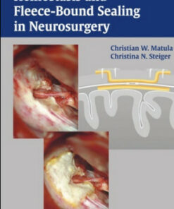 Hemostasis and Fleece-Bound Sealing in Neurosurgery