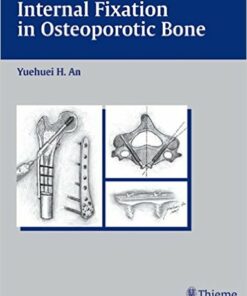 Internal Fixation in Osteoporotic Bone 1st Edition
