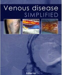 Venous Disease Simplified
