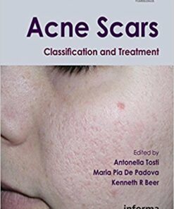 Acne Scars: Classification and Treatment (Series in Dermatological Treatment) 1st Edition PDF