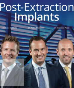 Post-Extraction Implants (Video course)