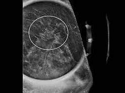 Imaging Mastery Series: High Risk Screening Breast MRI 2021