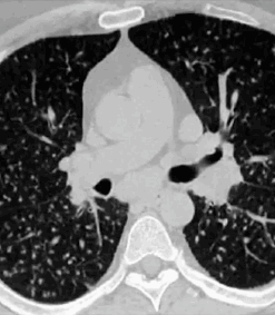 Imaging Mastery Series: Micronodules 2021