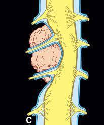 MRIOnline MRI Mastery Series: Extradural Lesions 2020