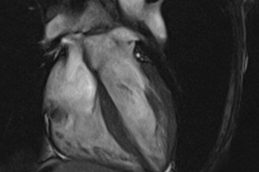 MRIOnline Mastery Series: Cardiac MRI of Non-Ischemic Cardiomyopathy 2021 (CME VIDEOS)