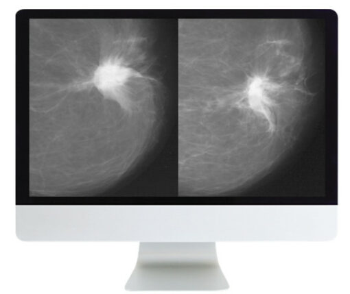 Harmonizing Breast Cancer Screening Recommendations Hybrid Course