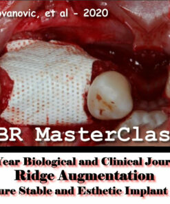 Guided Bone Regeneration – a 30-year Biological and Clinical Journey in Ridge Augmentation to Ensure Stable and Esthetic Implant Results