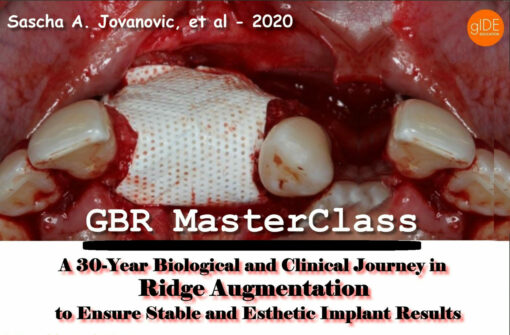 Guided Bone Regeneration – a 30-year Biological and Clinical Journey in Ridge Augmentation to Ensure Stable and Esthetic Implant Results