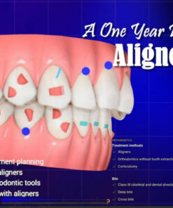 OHI-S A One Year Program on Aligner Therapy