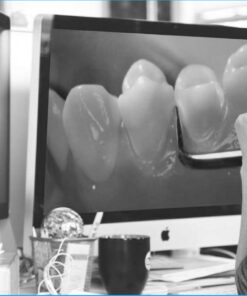 Bicuspid Veneer and V-Onlay Preparation