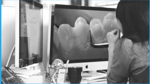 Bicuspid Veneer and V-Onlay Preparation