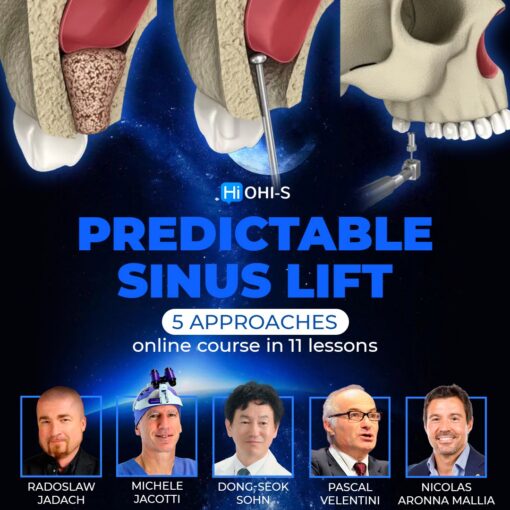 OHI-S Predictable Sinus Lift