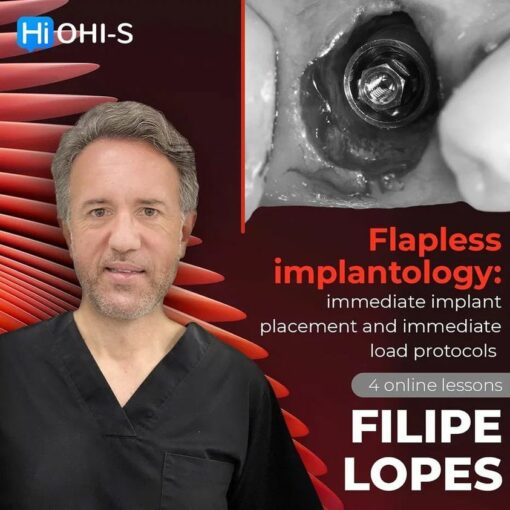OHI-S Flapless Implantology,  Protocols for Immediate Implant Placement and Loading - Filipe Lopes