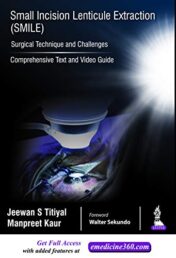 Small Incision Lenticule Extraction (SMILE): Surgical Technique and Challenges (Comprehensive Text and Video Guide) (Original PDF)