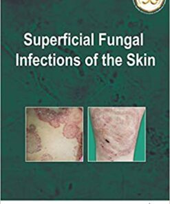 Superficial Fungal Infections of the Skin (Original PDF from Publisher)