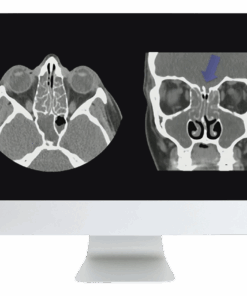 ARRS Cranial Nerve Imaging: From the Least to the Last 2022 ( Videos + CME Questions)
