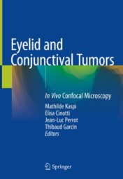 Eyelid and Conjunctival Tumors In Vivo Confocal Microscopy 2020 ORIGINAL PDF