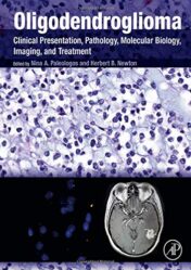 Oligodendroglioma: Clinical Presentation, Pathology, Molecular Biology, Imaging, and Treatment (Original PDF)