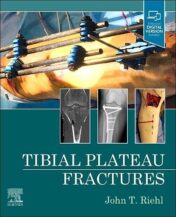 Tibial Plateau Fractures 2022 EPUB + Converted PDF
