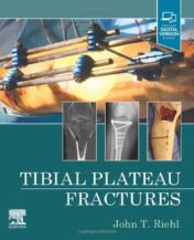 Tibial Plateau Fractures 2022 Original PDF