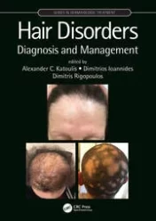 Hair Disorders Diagnosis and Management 2021 Original pdf