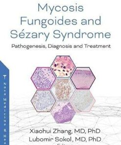 Mycosis Fungoides: Causes, Diagnosis and Treatment (Original PDF from Publisher)