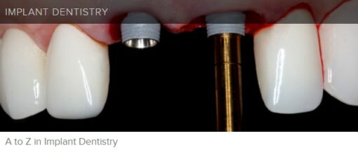 gIDE A to Z in Implant Dentistry