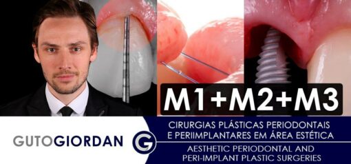 Aesthetic Periodontal and Peri-Implant Plastic Surgeries