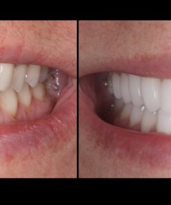 All New Simplifying Complex: Occlusion & Full Mouth Restorative Cases From Start to Finish.