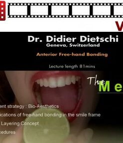 Anterior Free-Hand Bonding