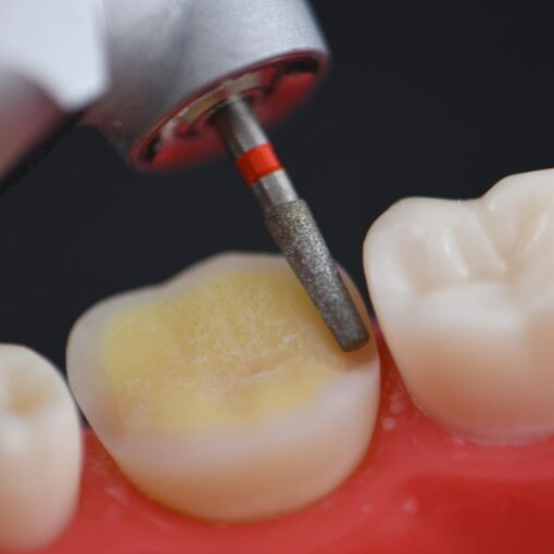BAARD Overlay & Onlay Preparation Design Course