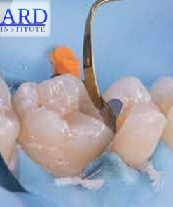 The Baard Biobases: Advanced Adhesive "Build Ups" & Deep Margin Elevation