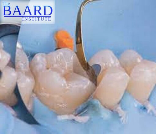 The Baard Biobases: Advanced Adhesive "Build Ups" & Deep Margin Elevation