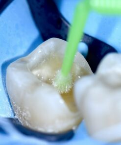 Baard Immediate Dentin Sealing & Advanced Adhesion for Indirects