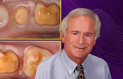 OHI- S Biologic Shaping: a conservative alternative to crown lengthening