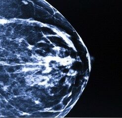 Breast Imaging and Digital Mammography