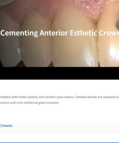 Classic Collection: Cementing Anterior Esthetic Crowns