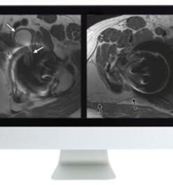 Controversies in Hip and Pelvis Imaging