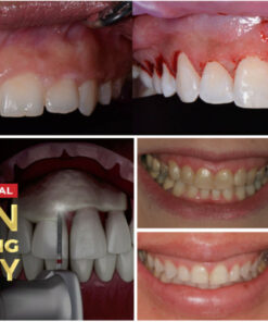 Crown Lengthening - surgicalmaster