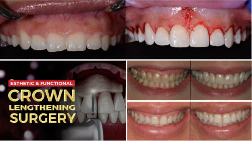 Crown Lengthening - surgicalmaster