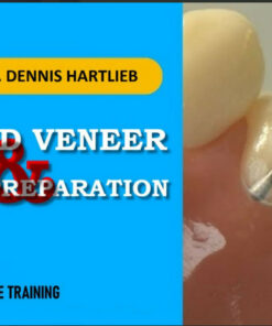 Bicuspid Veneer & V-Onlay Preparation - Dennis Hartlieb
