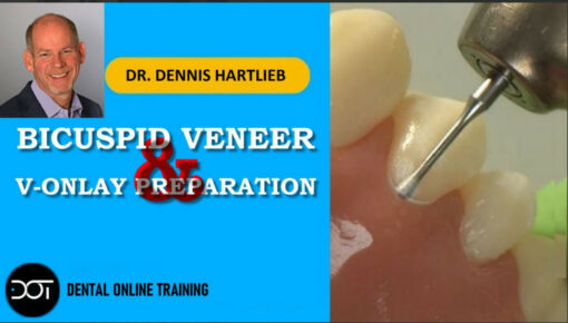 Bicuspid Veneer & V-Onlay Preparation - Dennis Hartlieb