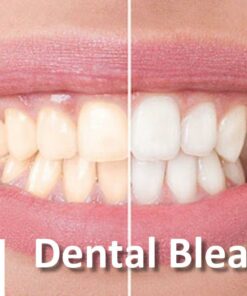 DentalXP Dental Bleaching